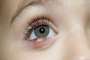 Mách bạn cách phân biệt chắp mắt và lẹo mắt